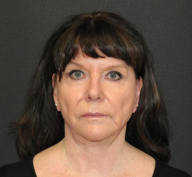 Mini Facelift before at Scottsdale Plastic Surgery in Scottsdale, AZ