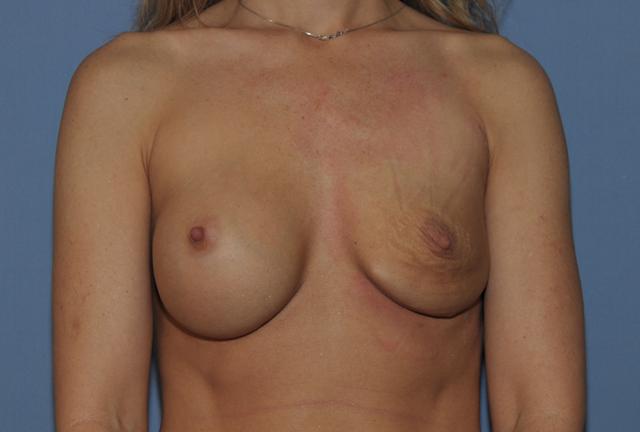 Breast Augmentation before at Scottsdale Plastic Surgery in Scottsdale, AZ
