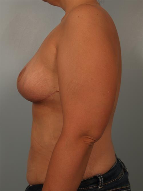 Breast Reduction after at Scottsdale Plastic Surgery in Paradise Valley, AZ