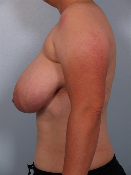 Breast Reduction before at Scottsdale Plastic Surgery in Paradise Valley, AZ