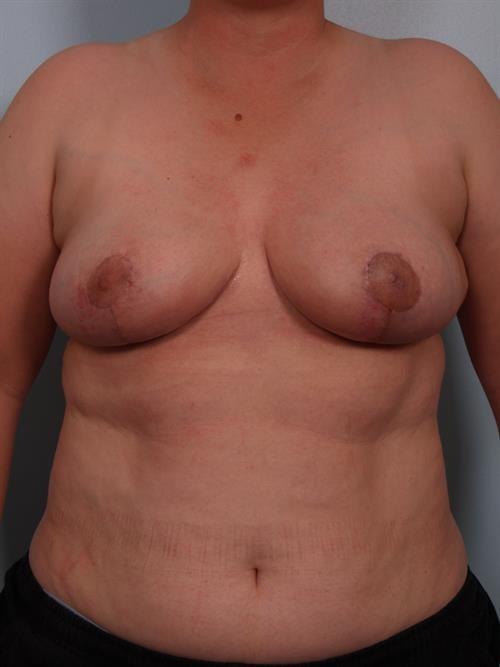 Breast Reduction after at Scottsdale Plastic Surgery in Paradise Valley, AZ