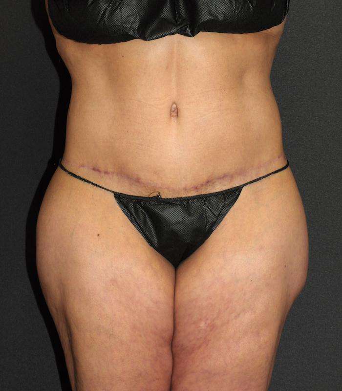 Scottsdale Plastic Surgery tummy tuck after — Scottsdale, AZ