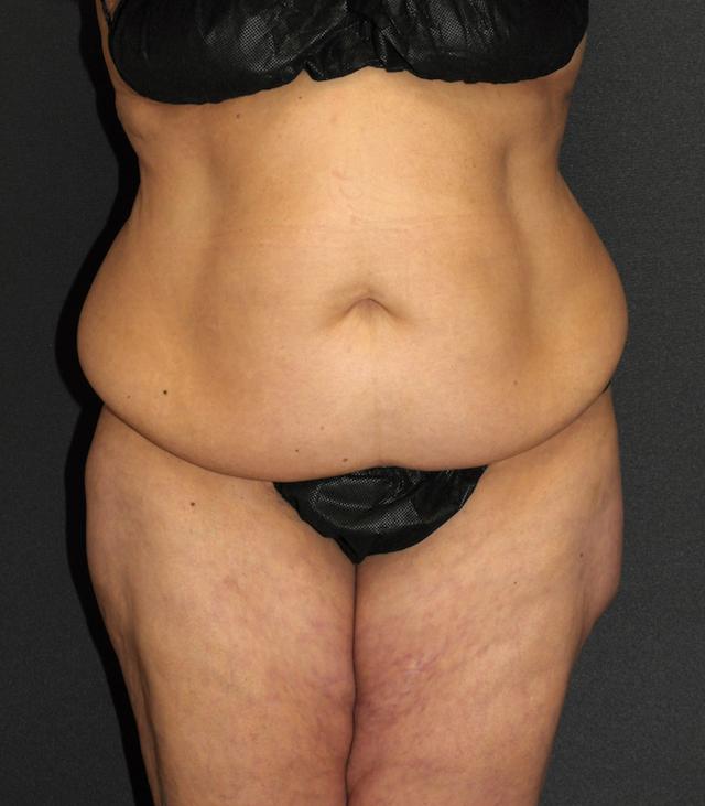 Tummy Tuck before at Scottsdale Plastic Surgery in Scottsdale, AZ