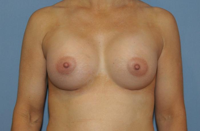 Scottsdale Plastic Surgery breast augmentation after — Scottsdale, AZ