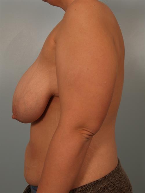 Breast Reduction before at Scottsdale Plastic Surgery in Paradise Valley, AZ