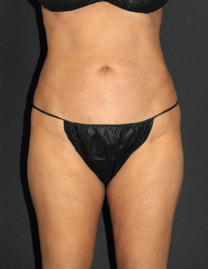 Scottsdale Plastic Surgery liposuction after — Scottsdale, AZ