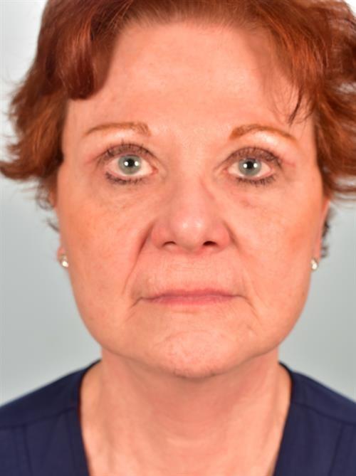 Facelift after at Scottsdale Plastic Surgery in Paradise Valley, AZ