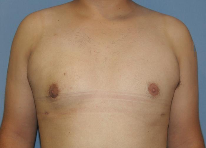 Scottsdale Plastic Surgery gynecomastia after — Scottsdale, AZ