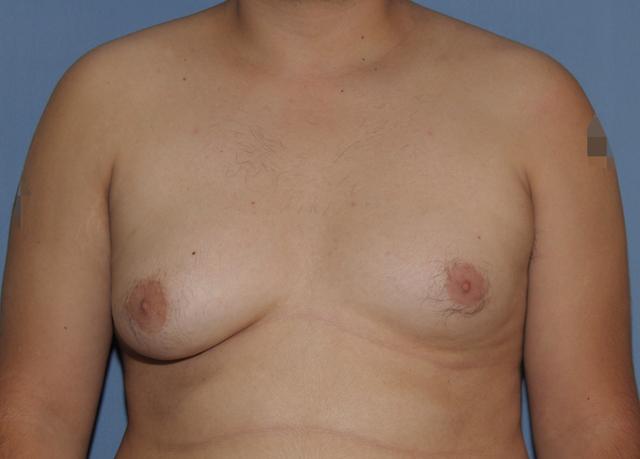 Gynecomastia Surgery before at Scottsdale Plastic Surgery in Scottsdale, AZ