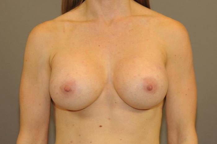 Scottsdale Plastic Surgery breast augmentation after — Scottsdale, AZ