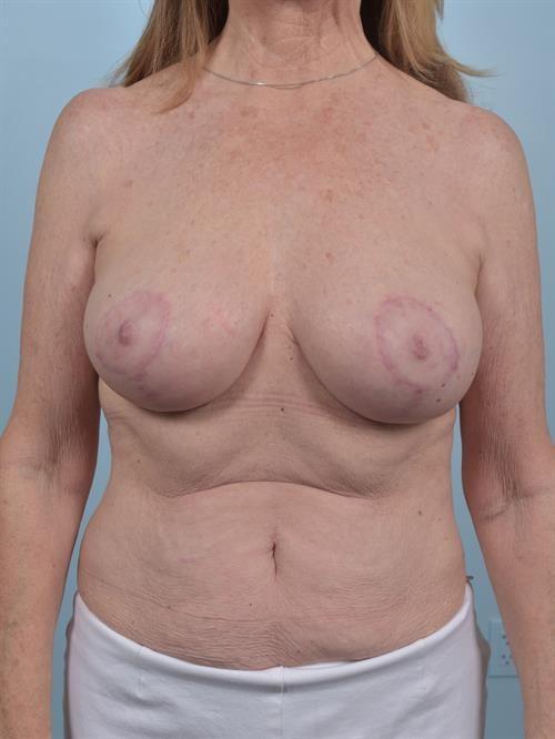 Breast Lift after at Scottsdale Plastic Surgery in Paradise Valley, AZ