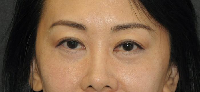 Scottsdale Plastic Surgery facelift after — Scottsdale, AZ