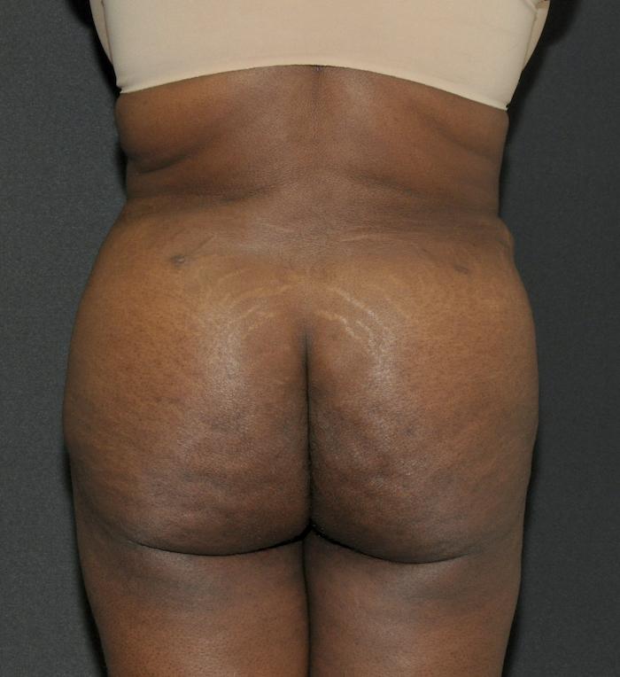 Scottsdale Plastic Surgery bbl after — Scottsdale, AZ