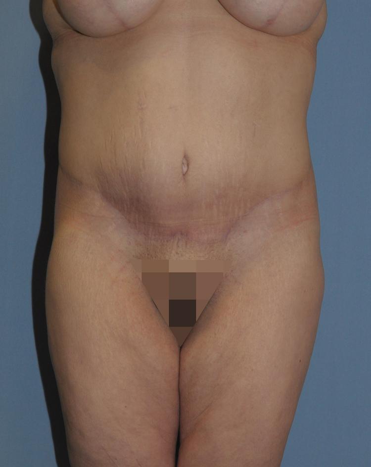Scottsdale Plastic Surgery tummy tuck after — Scottsdale, AZ