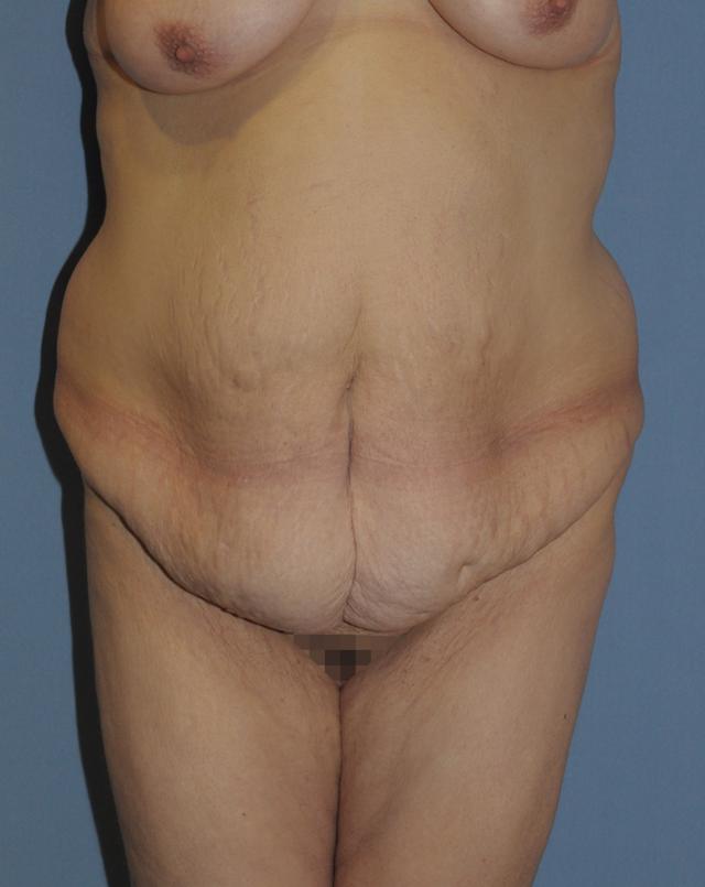 Mini Tummy Tuck before at Scottsdale Plastic Surgery in Paradise Valley, AZ