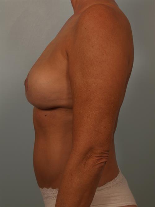 Scottsdale Plastic Surgery breast fat transfer after — Paradise Valley, AZ