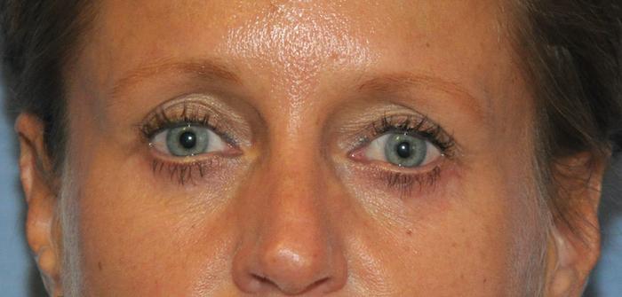 Scottsdale Plastic Surgery facelift after — Scottsdale, AZ