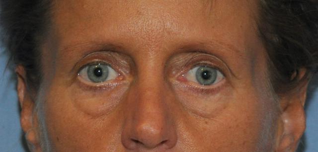 Blepharoplasty before at Scottsdale Plastic Surgery in Scottsdale, AZ