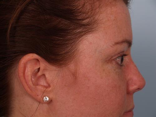 Blepharoplasty after at Scottsdale Plastic Surgery in Paradise Valley, AZ