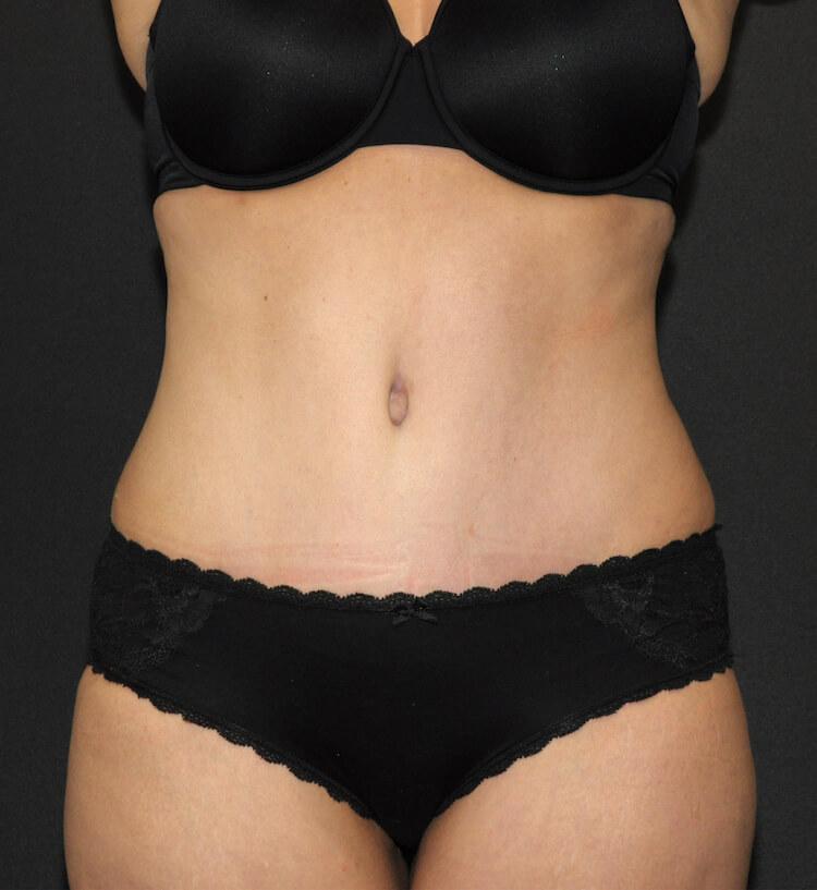 Scottsdale Plastic Surgery tummy tuck after — Scottsdale, AZ