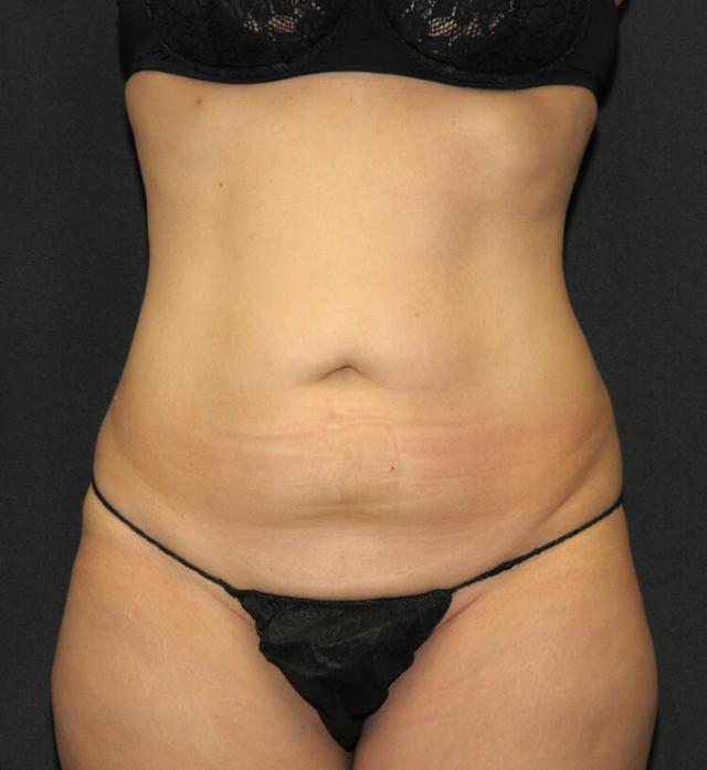 Mini Tummy Tuck before at Scottsdale Plastic Surgery in Paradise Valley, AZ