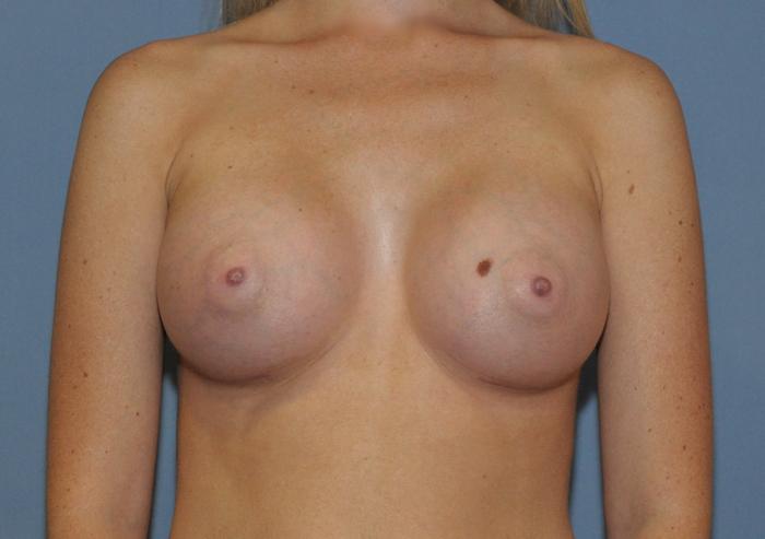 Scottsdale Plastic Surgery breast augmentation after — Scottsdale, AZ