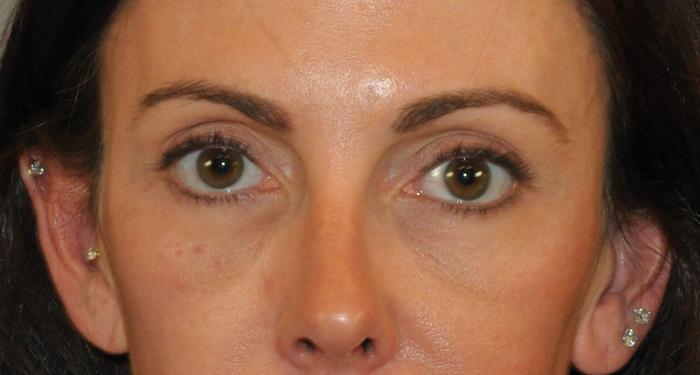 Scottsdale Plastic Surgery facelift after — Scottsdale, AZ