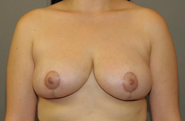 Breast Reduction after at Scottsdale Plastic Surgery in Scottsdale, AZ