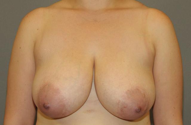 Breast Reduction before at Scottsdale Plastic Surgery in Scottsdale, AZ