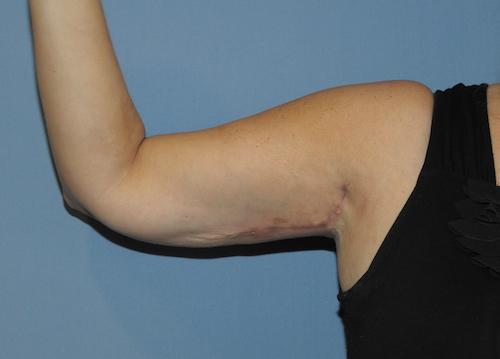 Arm Lift after at Scottsdale Plastic Surgery in Scottsdale, AZ