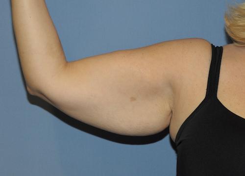 Arm Lift before at Scottsdale Plastic Surgery in Scottsdale, AZ