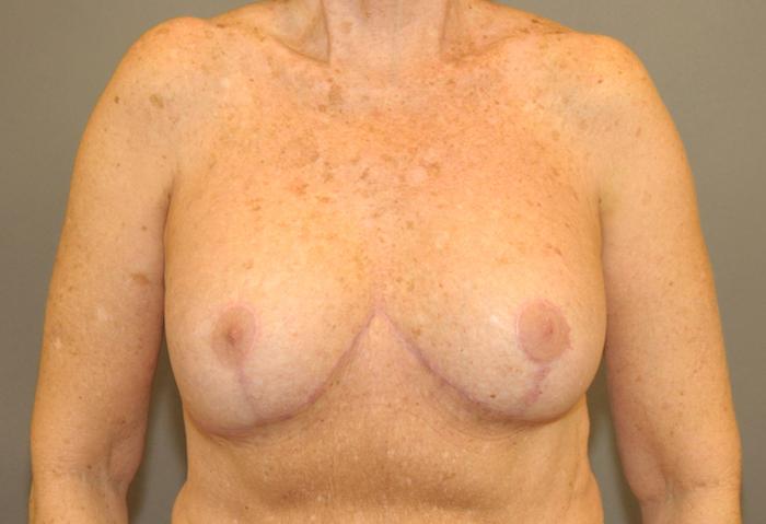 Scottsdale Plastic Surgery breast augmentation after — Scottsdale, AZ
