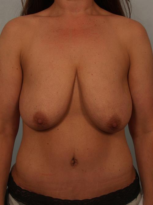 Breast Lift before at Scottsdale Plastic Surgery in Paradise Valley, AZ