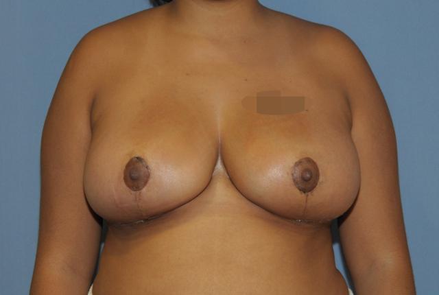 Breast Reduction after at Scottsdale Plastic Surgery in Scottsdale, AZ