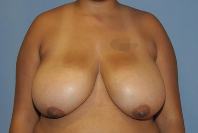 Breast Reduction before at Scottsdale Plastic Surgery in Scottsdale, AZ