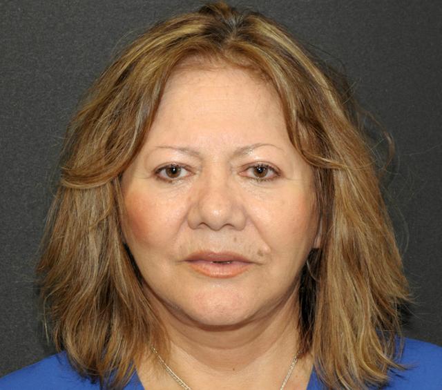Facelift after at Scottsdale Plastic Surgery in Paradise Valley, AZ