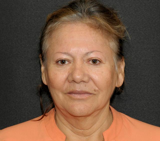 Facelift before at Scottsdale Plastic Surgery in Paradise Valley, AZ
