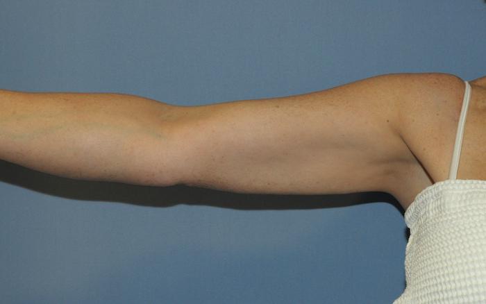 Scottsdale Plastic Surgery liposuction after — Scottsdale, AZ