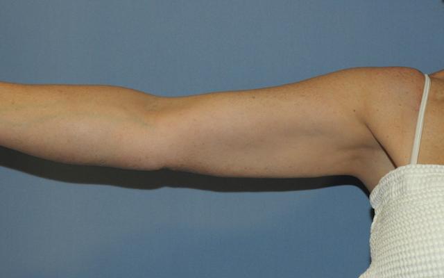 Liposuction after at Scottsdale Plastic Surgery in Scottsdale, AZ