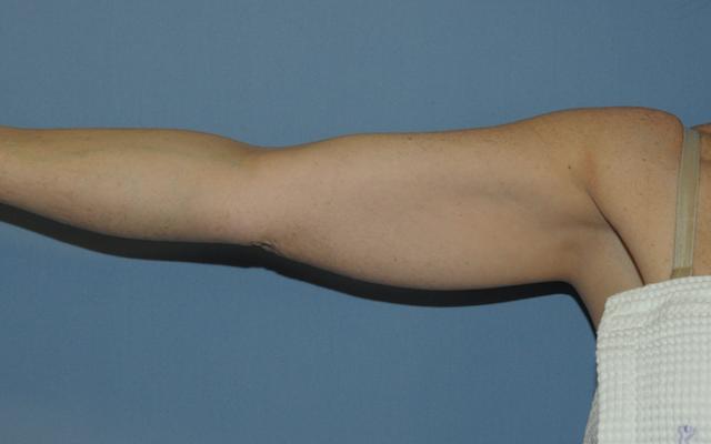 Liposuction before at Scottsdale Plastic Surgery in Scottsdale, AZ
