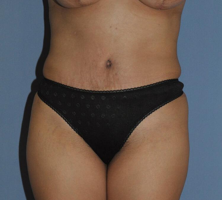 Scottsdale Plastic Surgery tummy tuck after — Scottsdale, AZ