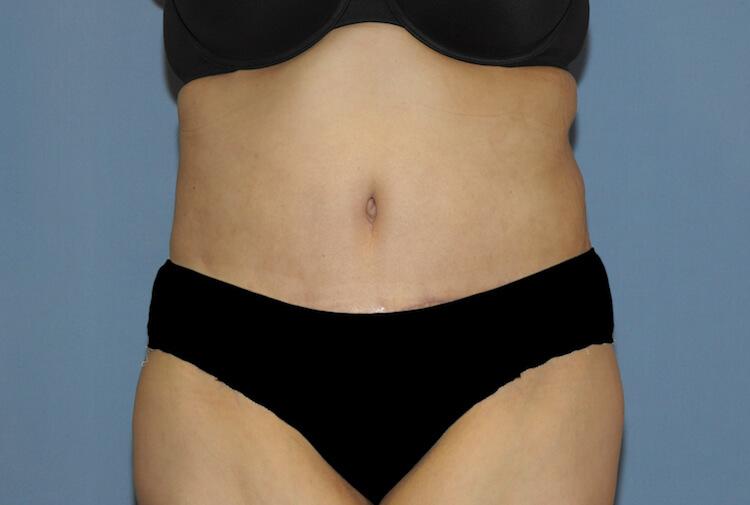 Scottsdale Plastic Surgery tummy tuck after — Scottsdale, AZ