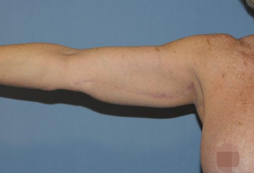 Arm Lift after at Scottsdale Plastic Surgery in Scottsdale, AZ