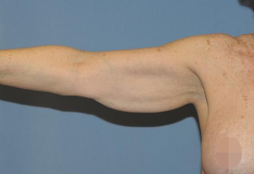 Arm Lift before at Scottsdale Plastic Surgery in Scottsdale, AZ