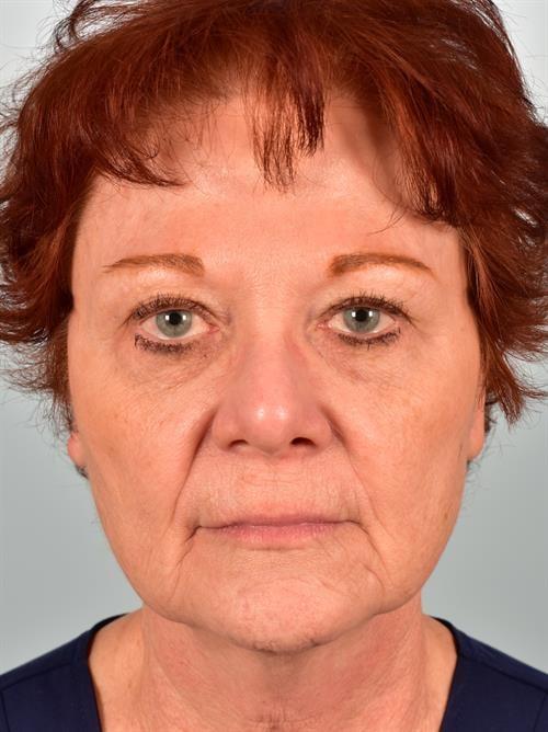Facelift before at Scottsdale Plastic Surgery in Paradise Valley, AZ
