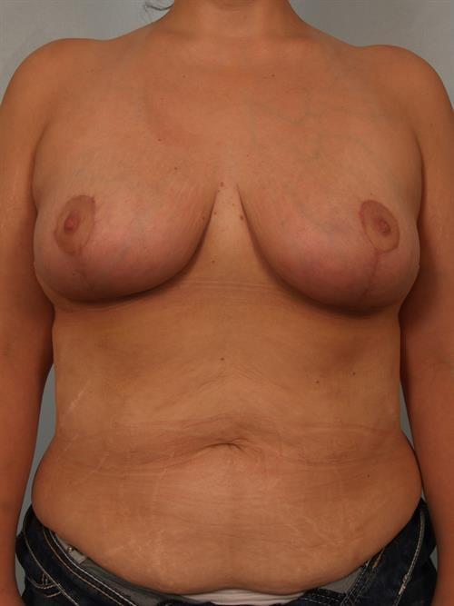 Breast Reduction after at Scottsdale Plastic Surgery in Paradise Valley, AZ