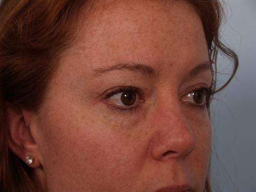 Blepharoplasty before at Scottsdale Plastic Surgery in Paradise Valley, AZ