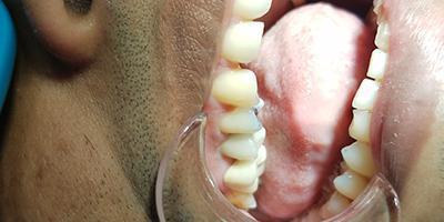 Smile Makeover after at Signature Smiles Dentistry of Plano in Plano, TX