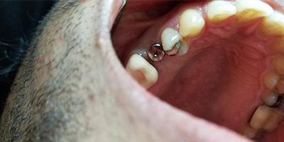 Smile Makeover before at Signature Smiles Dentistry of Plano in Plano, TX
