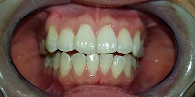 Signature Smiles Dentistry of Plano teeth whitening after — Plano, TX